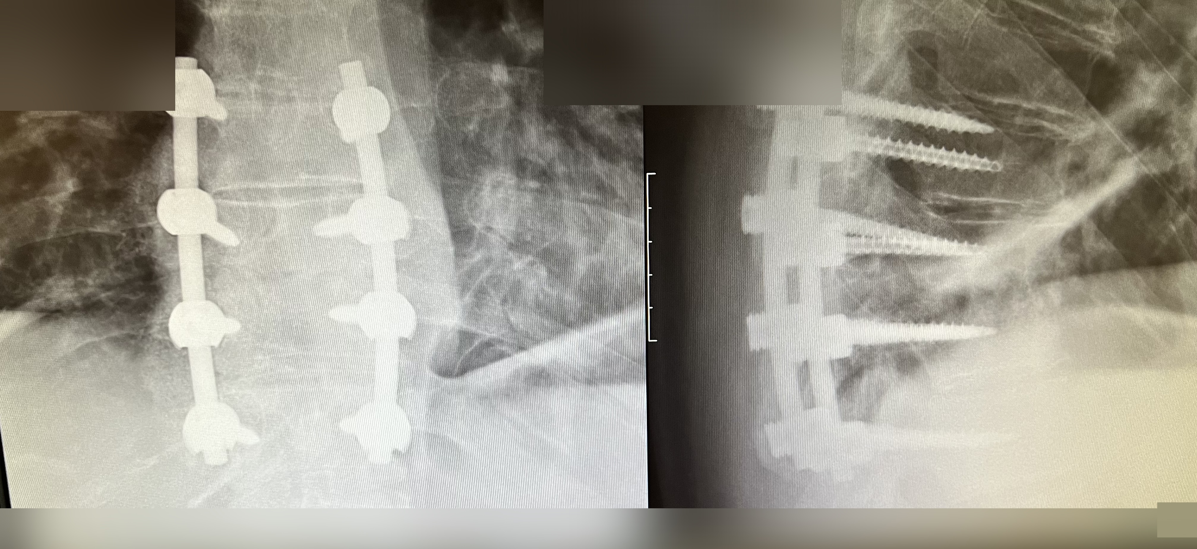 X-ray of Anthony's spine showing rods and 12 screws